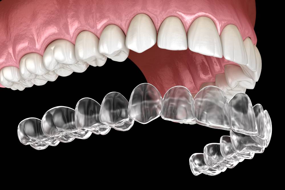 Invisalign Tampa