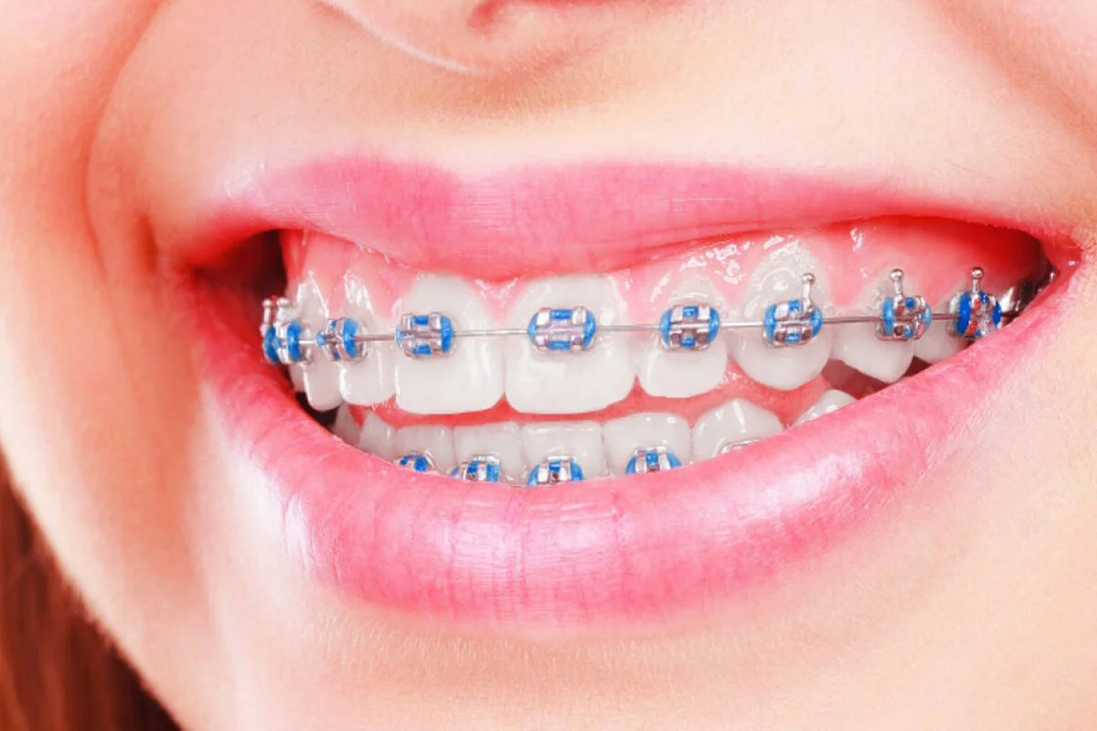 Traditional Braces in Tampa FL